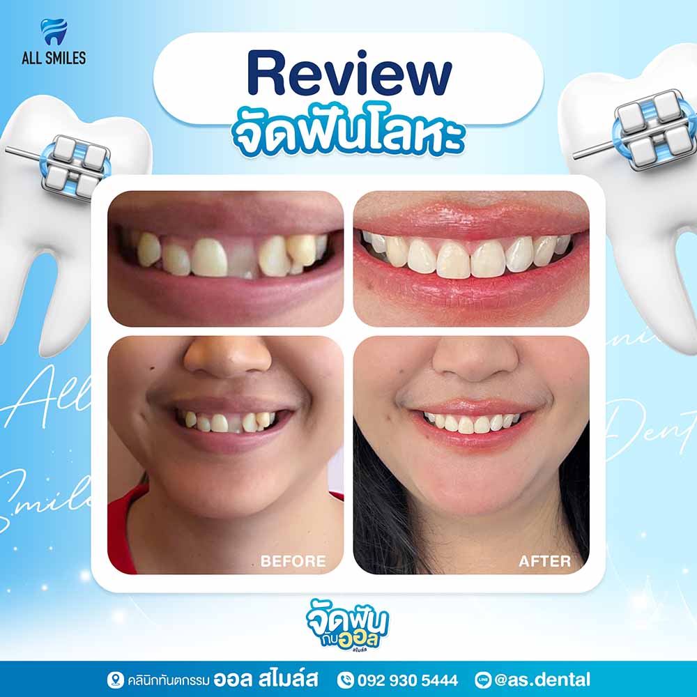 จัดฟันโลหะ1