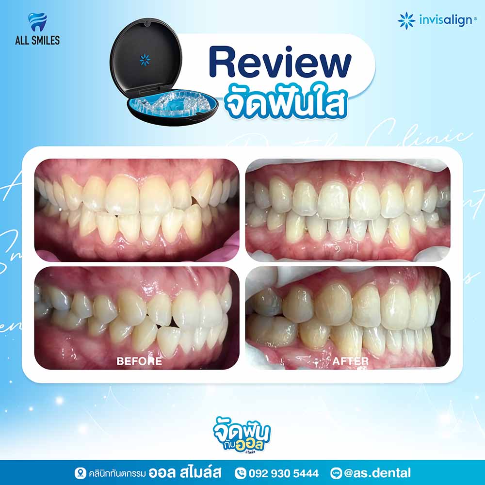 จัดฟันใส