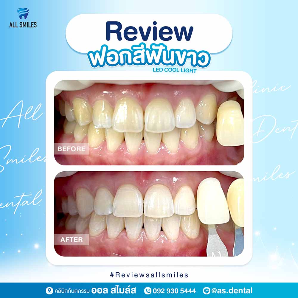 ฟอกสีฟันขาว1