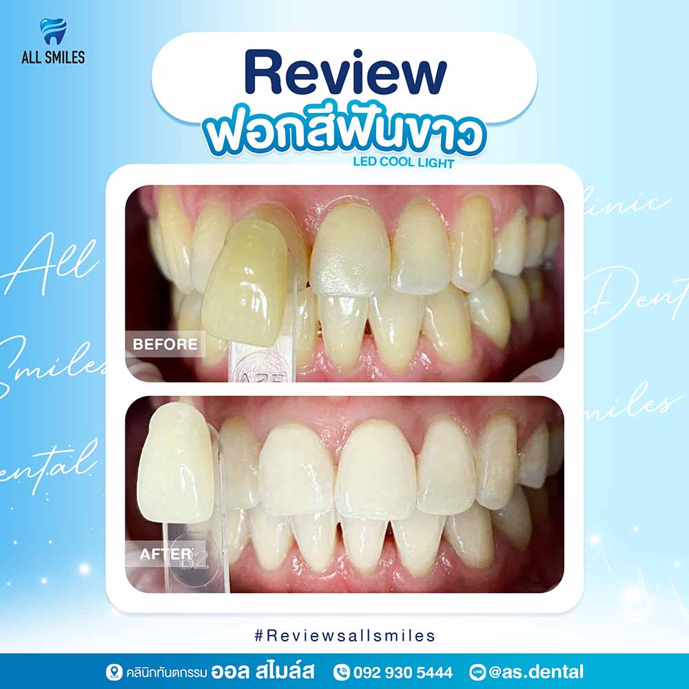 ฟอกสีฟันขาว3