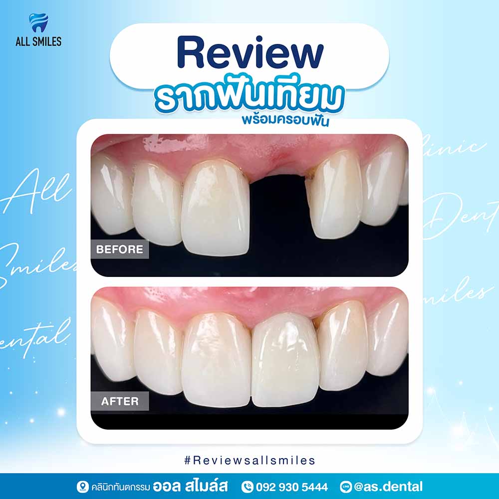 รากฟันเทียม2