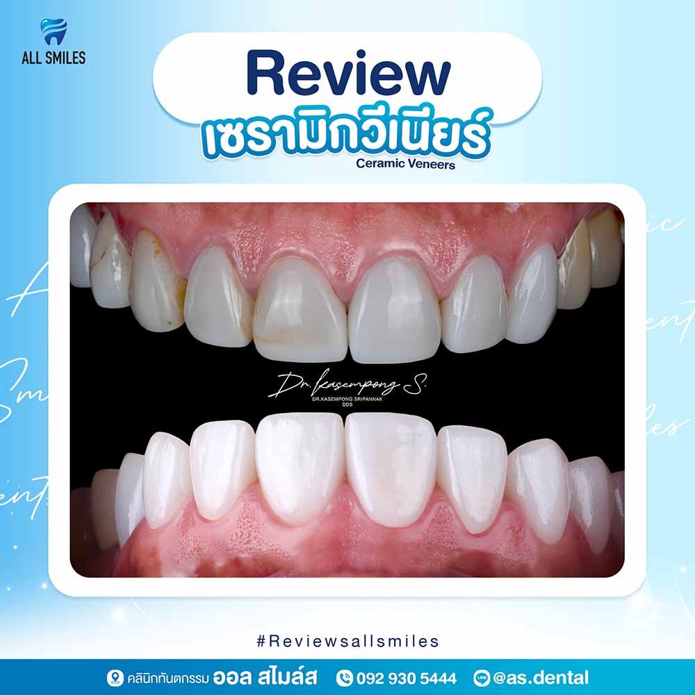 เซรามิกวีเนียร์1