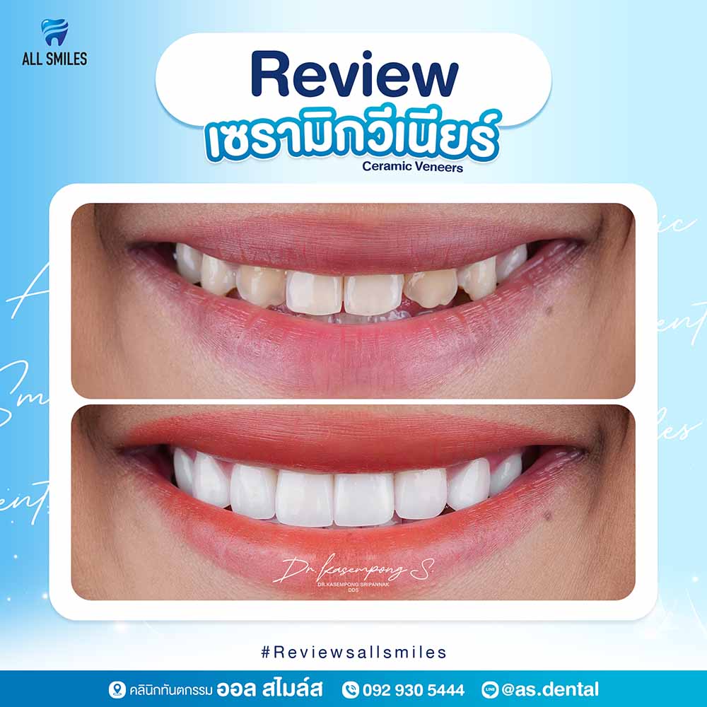 เซรามิกวีเนียร์3