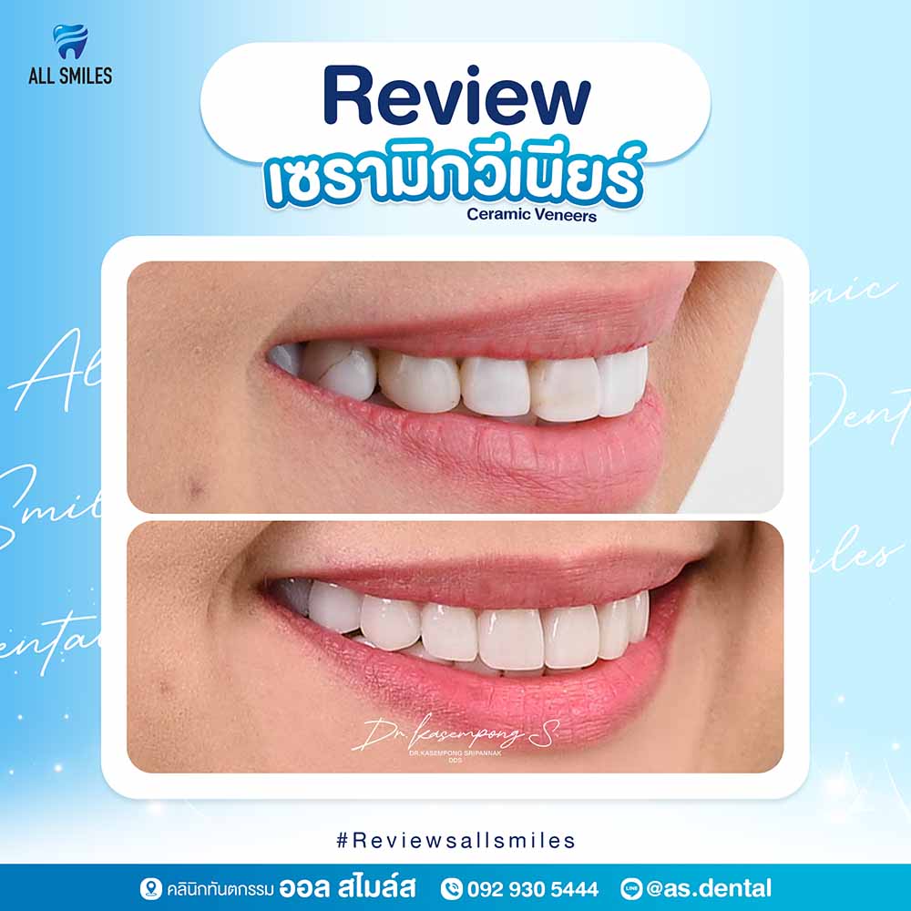 เซรามิกวีเนียร์4