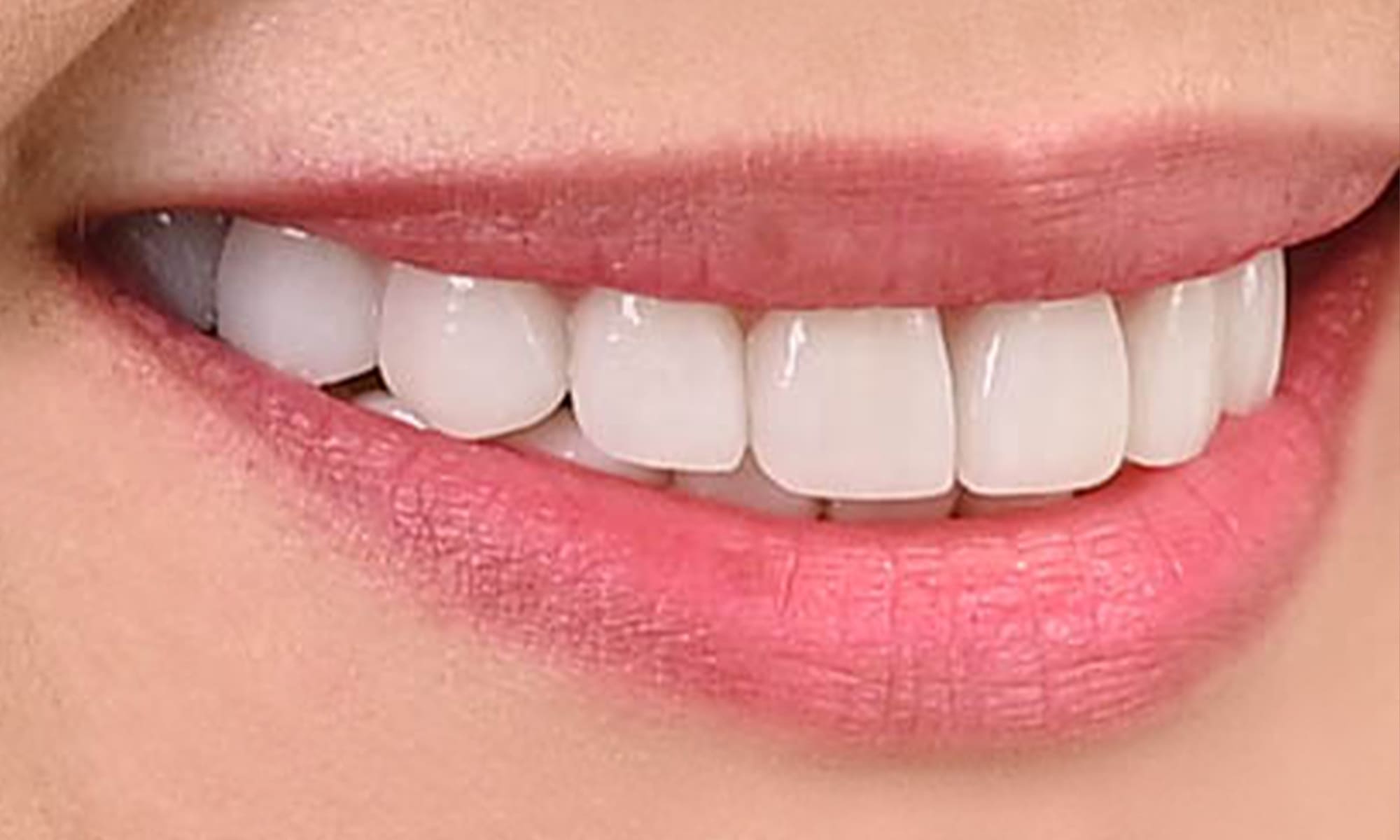 CeramicVeneers3_2