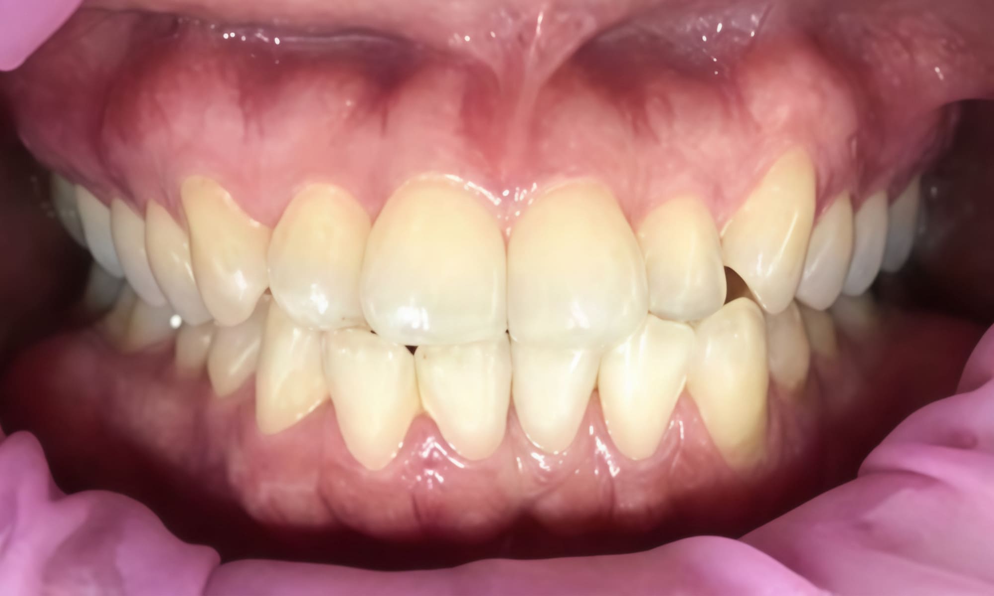 invisalign2_1