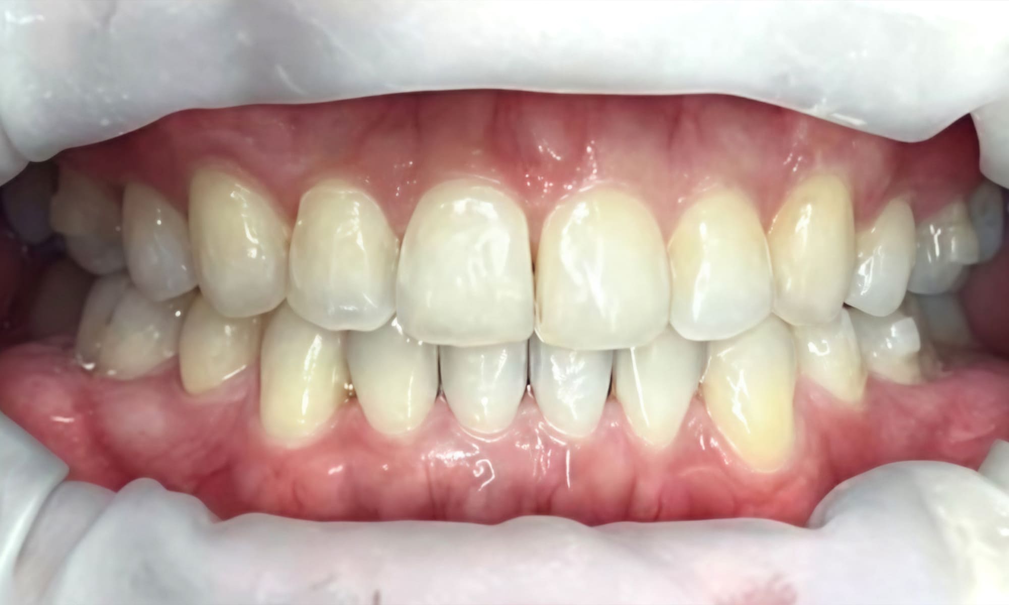 invisalign2_2