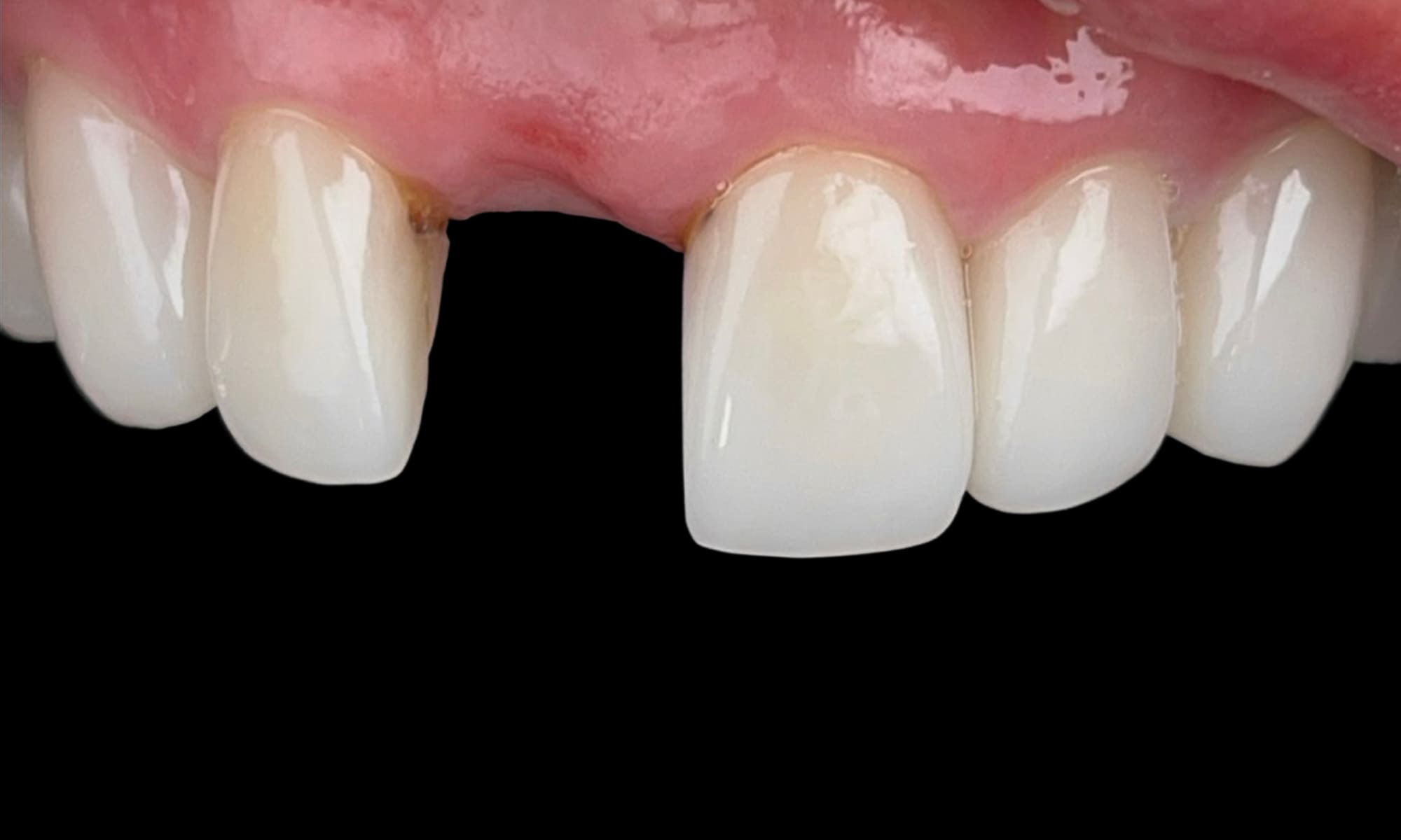 รากฟันเทียม1_1.1