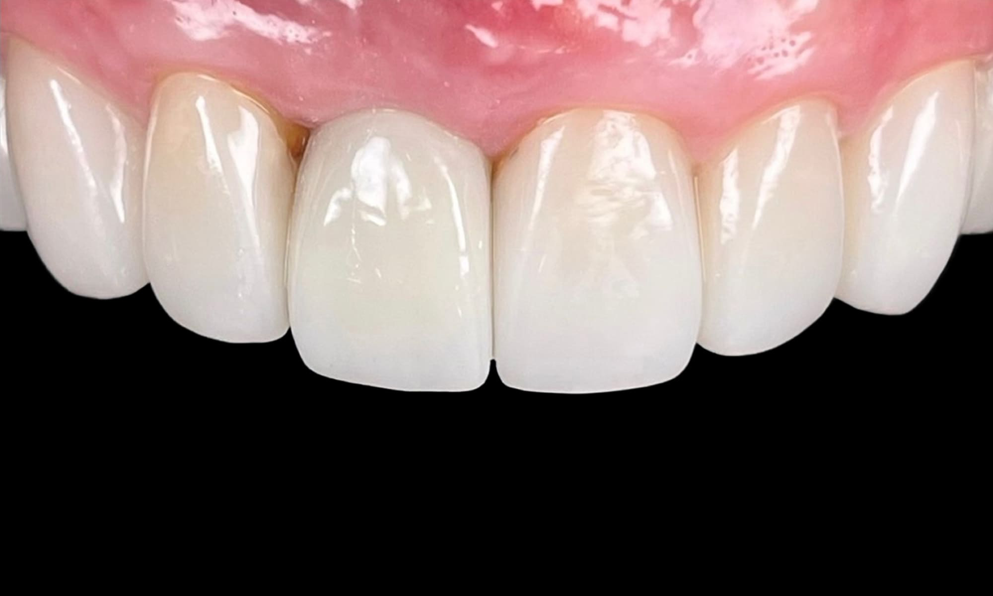 รากฟันเทียม1_2.1